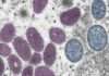Bahia tem 53 casos de Monkeypox