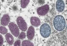 Bahia tem 53 casos de Monkeypox