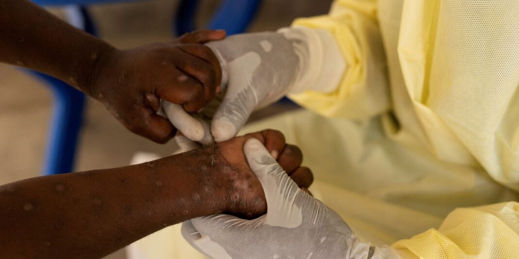 Mpox: OMS pede resposta após registro de nova variante na Mpox: OMS pede resposta após registro de nova variante na Suécia