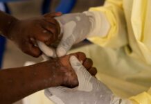 Mpox: OMS pede resposta após registro de nova variante na Suécia Mpox: OMS pede resposta após registro de nova variante na Suécia